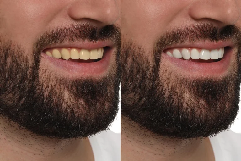 Composite Veneers 1